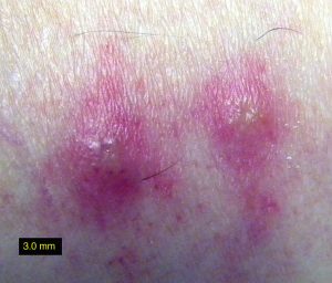 Trombiculosis sores from chigger bites on human ankle skin 